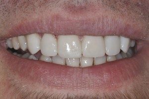 After getting dental veneers placed, Foundations of Health Dental Care, Dentist St. Joseph, MO